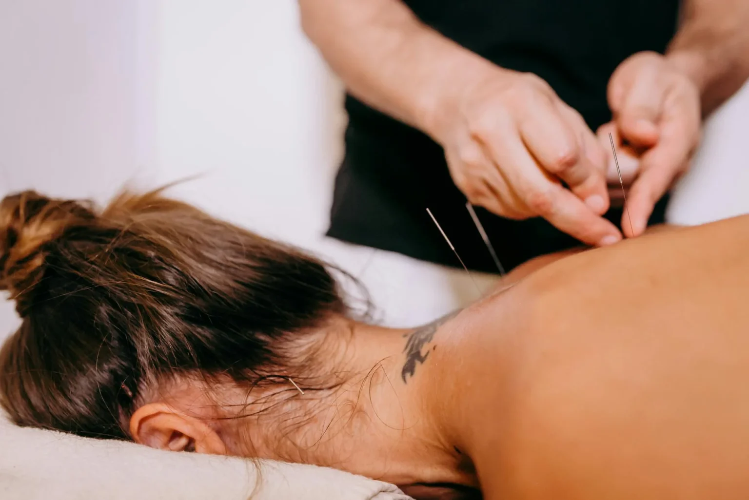 Alternative therapy: acupunctureon women's back